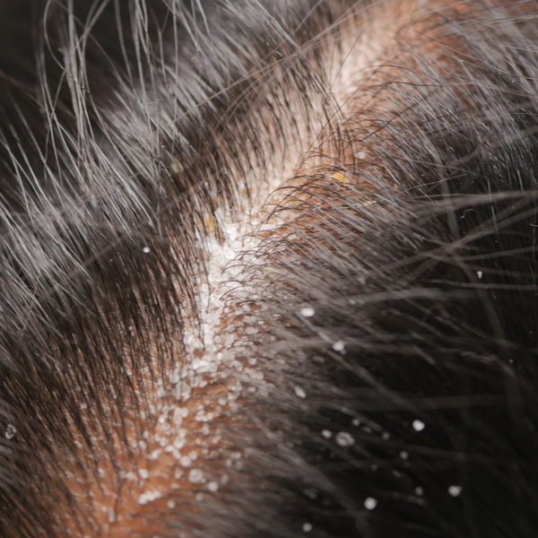 Scalp psoriasis