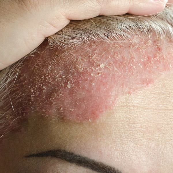 Seborrheic dermatitis