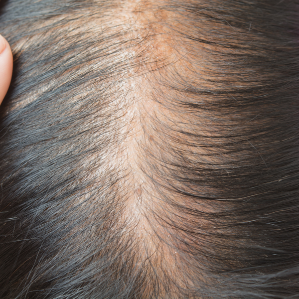 Thinning hair and alopecia