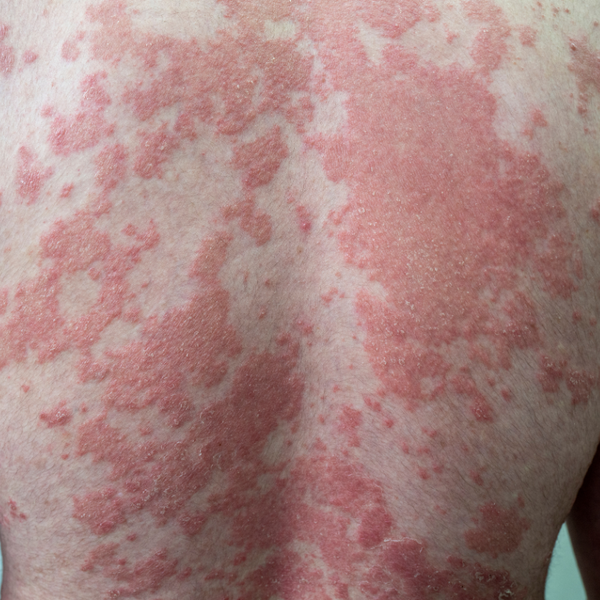 Psoriasis plaques