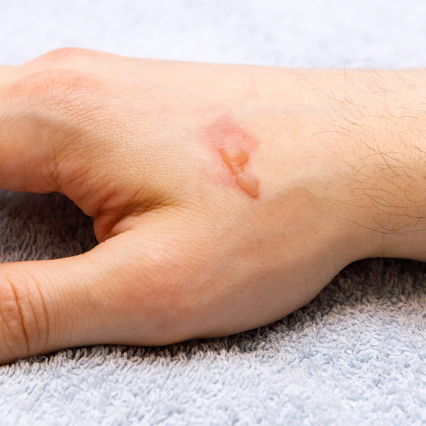 Wound healing and repair