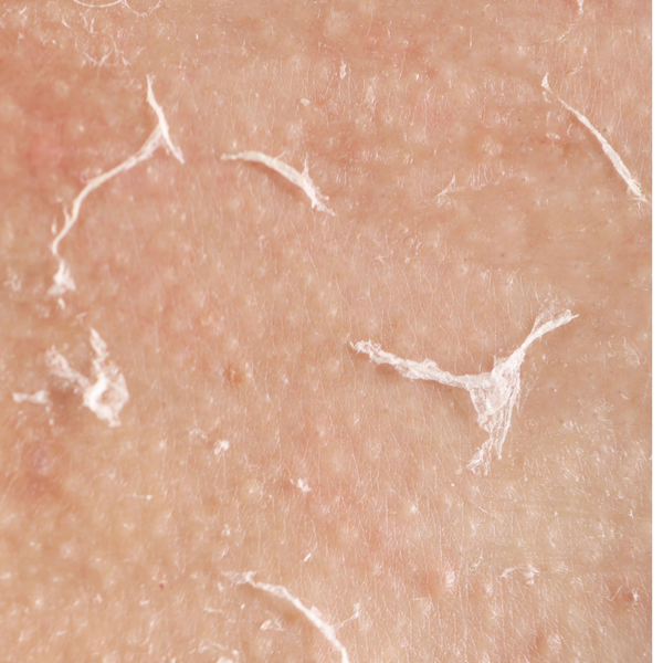 Dry and compromised skin